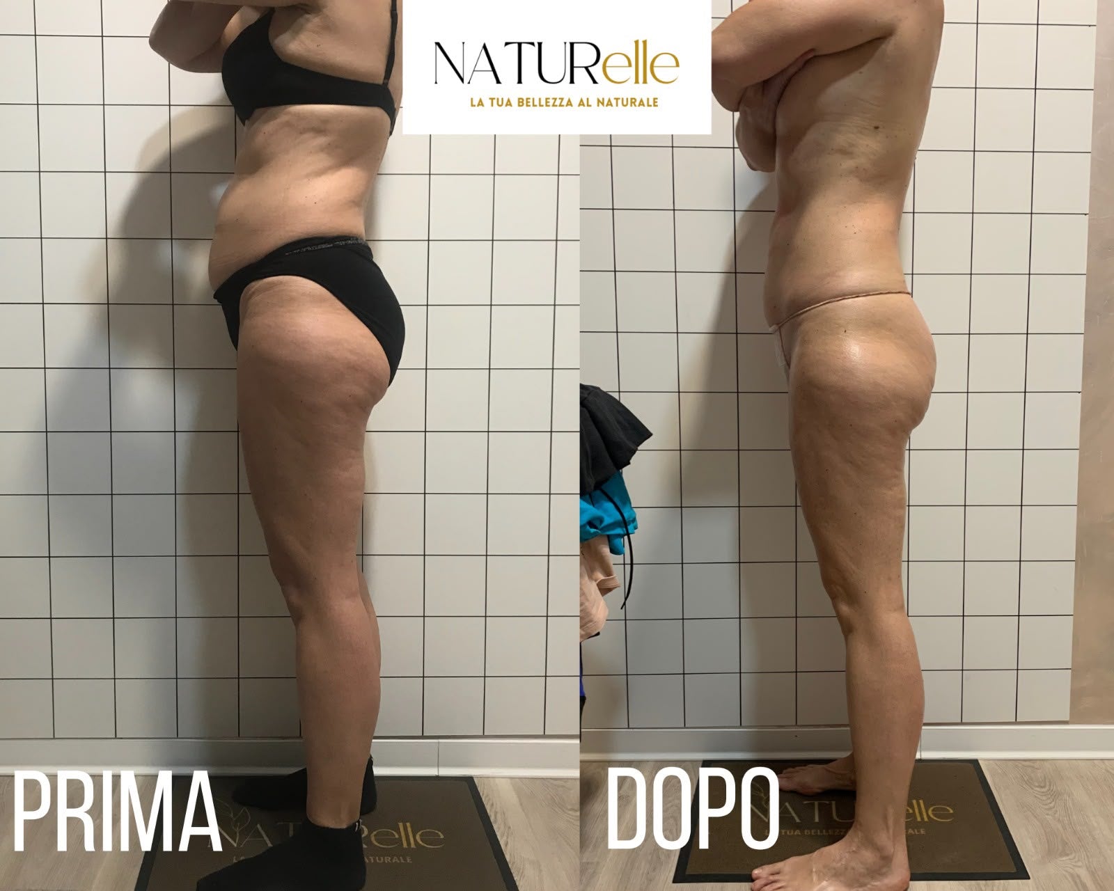 Non e' la cellulite il problema.E' quanto ti condiziona.